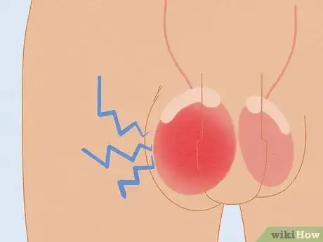 Image titled Recognize Chlamydia Symptoms (for Men) Step 4
