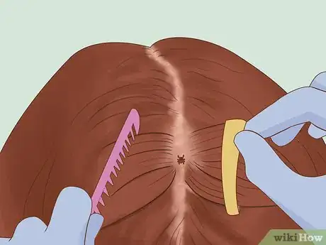 Image titled Get Rid of Ticks in Your Hair Step 4