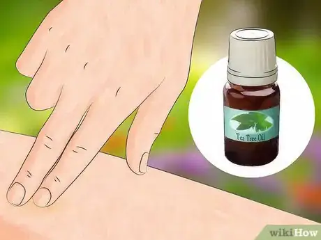 Image titled Get Bug Bites to Stop Itching Step 3