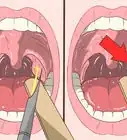 Remove Tonsil Stones (Tonsilloliths)