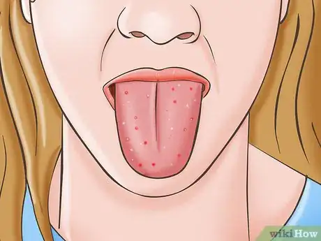 Image titled Know if You Have Oral Thrush Step 1