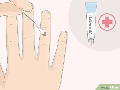 Image titled Get Rid of Warts Step 9