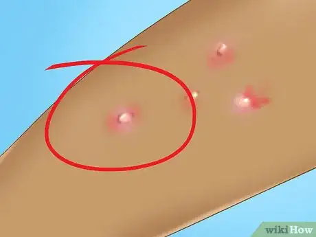 Image titled Recognize Molluscum (Molluscum Contagiosum) Step 3