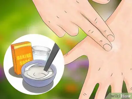 Image titled Get Bug Bites to Stop Itching Step 6