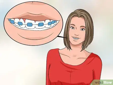 Image titled Choose the Color of Your Braces Step 4
