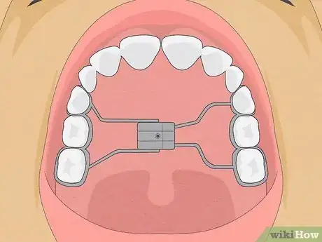 Image titled Straighten Your Teeth Without Braces Step 13