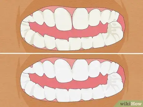 Image titled Straighten Your Teeth Without Braces Step 16