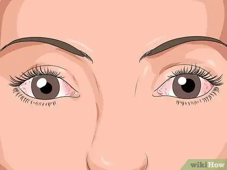 Image titled Get Rid of Pink Eye Fast Step 1