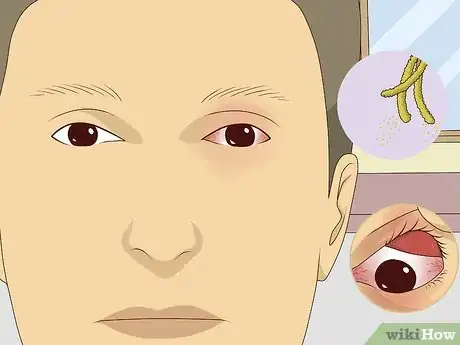 Image titled Stop Your Eye from Itching Step 2