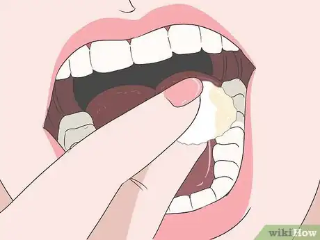 Image titled Reduce Wisdom Tooth Swelling Step 5