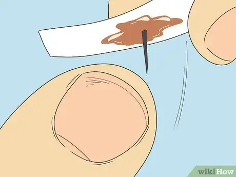 Image titled Remove a Splinter Under Your Fingernail Step 8