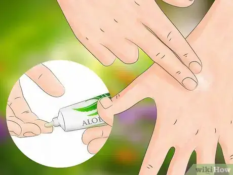 Image titled Get Bug Bites to Stop Itching Step 8