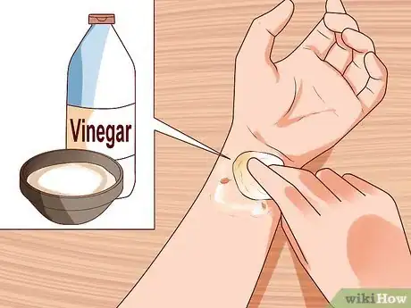 Image titled Remove Warts Naturally Using Garlic Step 8