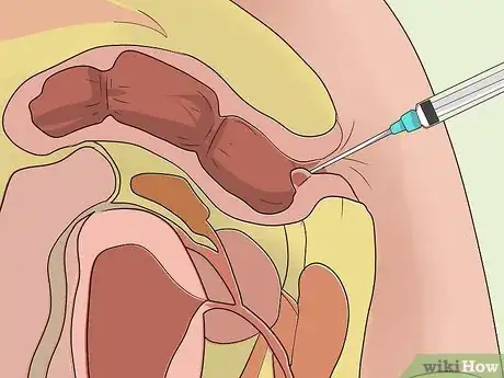 Image titled Stop Bleeding Hemorrhoids Step 9