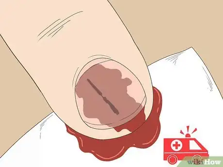 Image titled Remove a Splinter Under Your Fingernail Step 1