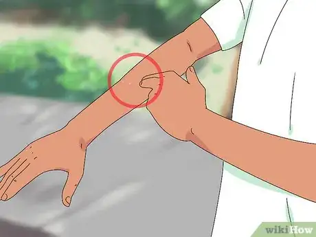 Image titled Treat a Snake Bite Step 16