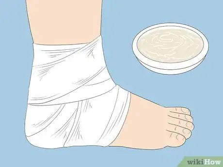 Image titled Treat Swollen Ankles and Feet for Lupus Nephritis Step 3