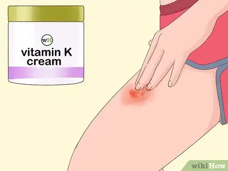 Image titled Get Rid of Bruises Step 13