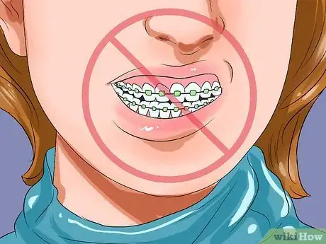 Image titled Clean Teeth With Braces Step 11