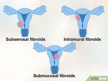 Image titled Diagnose Uterine Fibroids Step 6
