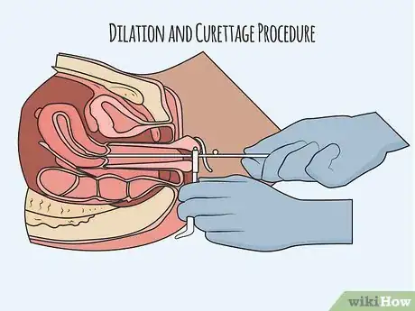 Image titled Remove Uterine Polyps Step 02