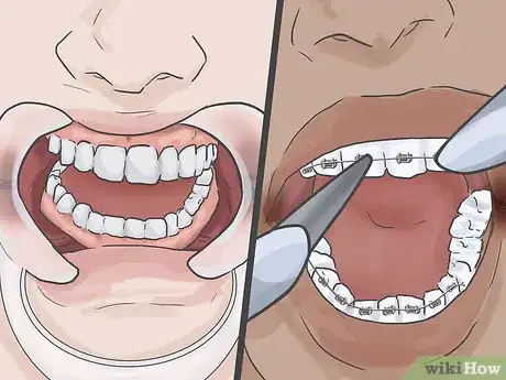 Image titled Heal Cracks in the Corners of Your Mouth Step 12