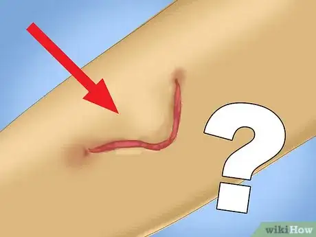 Image titled Treat a Skin Flap or Abrasion During First Aid Step 4