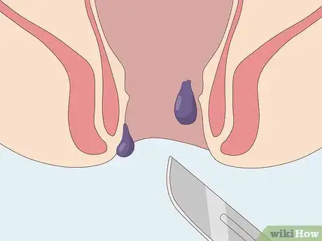 Image titled Treat Pregnancy Hemorrhoids Step 13