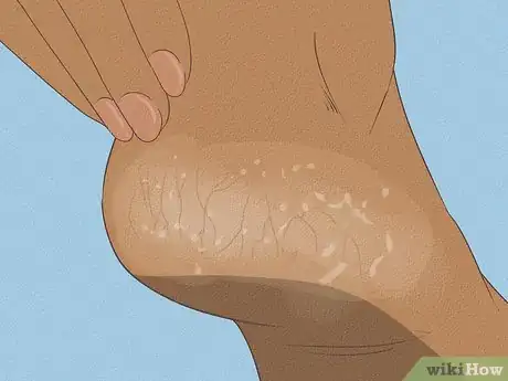 Image titled Get Rid of Dry Skin on Feet Step 2