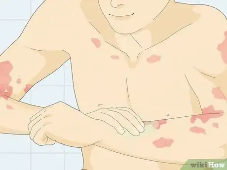 Image titled Use Aloe Vera to Treat Eczema Step 7