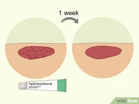 Image titled Treat Hypergranulation Step 8