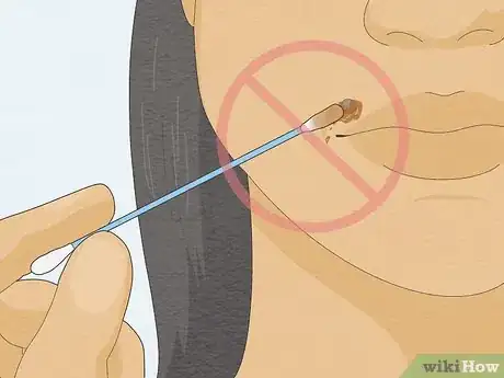 Image titled Remove a Mole with Iodine Step 14