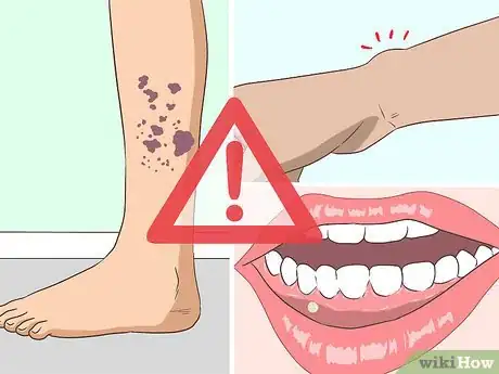 Image titled Diagnose Vasculitis Step 5