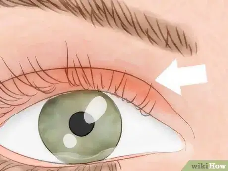 Image titled Know if You Have Eye Mites Step 3