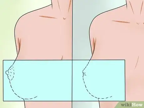 Image titled Know if You Have Breast Cancer Step 10