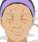 Remove Deep Facial Wrinkles