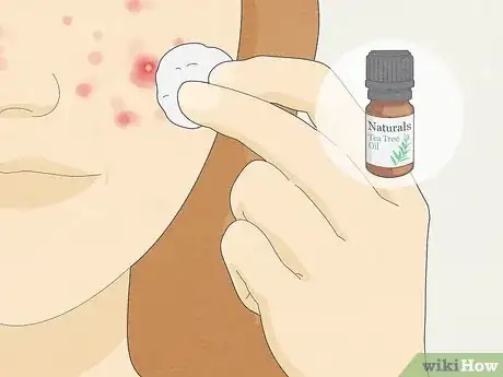 Image titled Get Rid of a Pimple Step 8