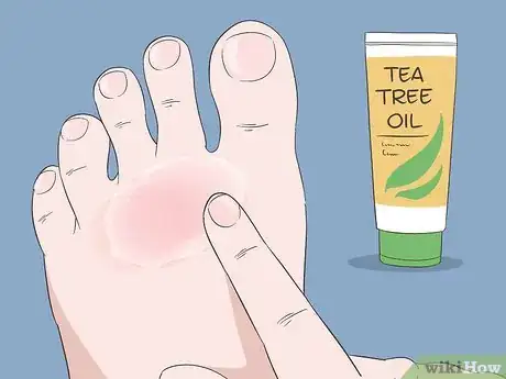 Image titled Cure Athlete's Foot Naturally Step 1