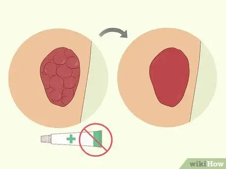 Image titled Treat Hypergranulation Step 3