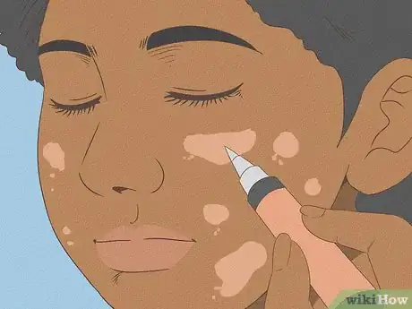 Image titled Get Rid of Spots on Your Skin Step 8