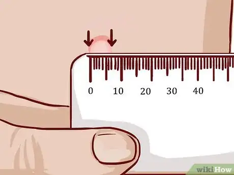 Image titled Read a Tuberculosis Skin Test Step 5