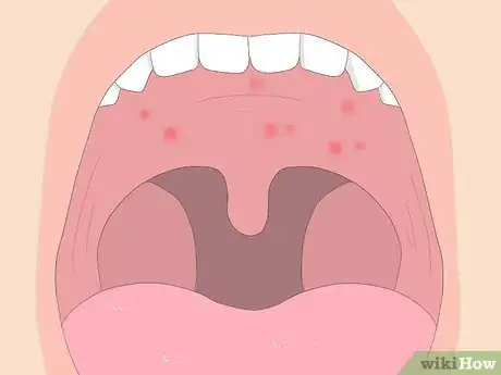 Image titled Tell if You Have Strep Throat Step 6