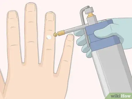 Image titled Get Rid of Warts Step 5