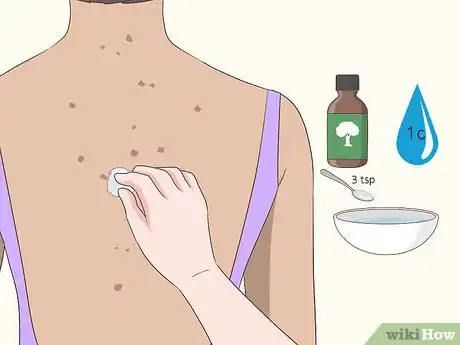 Image titled Get Rid of Back Acne Scars Step 5