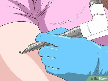 Image titled Remove Moles Without Surgery Step 6