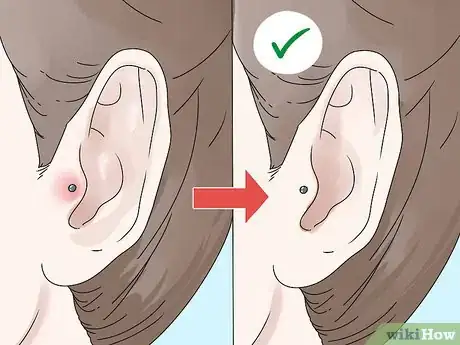 Image titled Take a Tragus Piercing Out Step 8