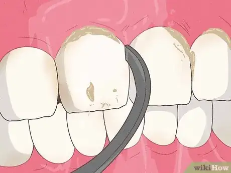 Image titled Stop Itchy Gums Step 13