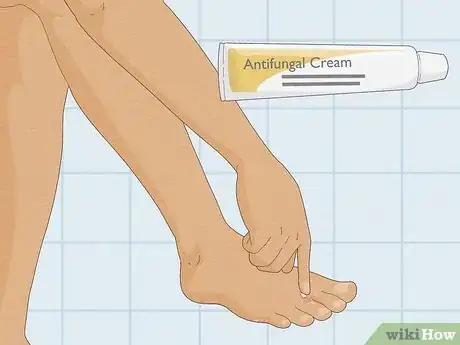 Image titled Treat and Prevent Athlete's Foot Step 1