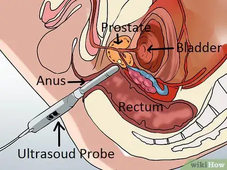 Image titled Recognize Prostate Cancer Symptoms Step 16