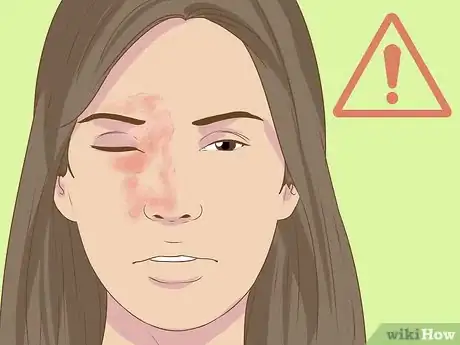 Image titled Recognize Shingles Symptoms (Herpes Zoster Symptoms) Step 12